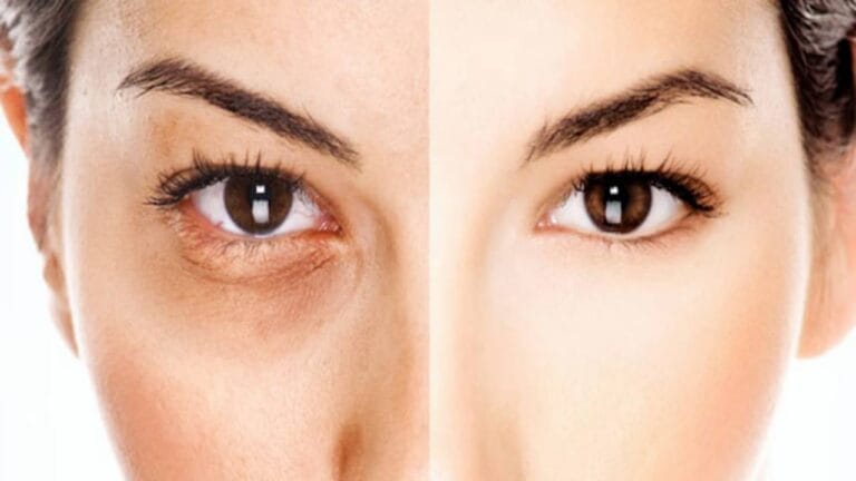 الهالات السوداء